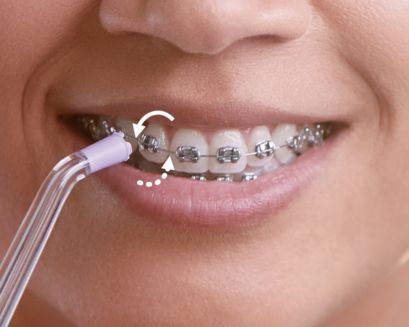 Patient with braces brushing front teeth.