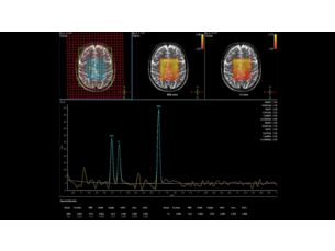 Spectroscopie Application clinique IRM