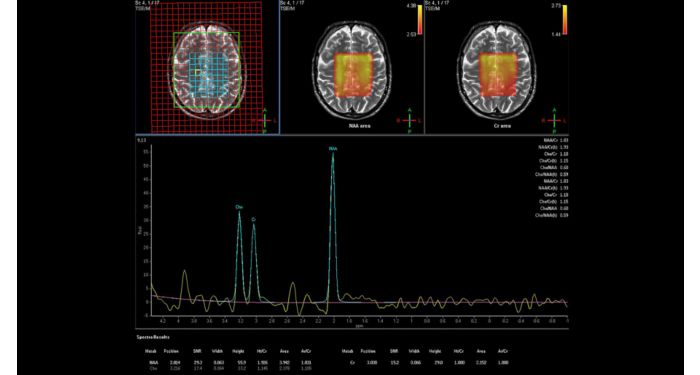 Spectroscopy Brain MR Clinical application | Philips