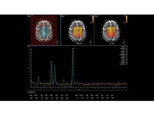 Spektroskopia — obrazowanie mózgu Zastosowania kliniczne obrazowania MR