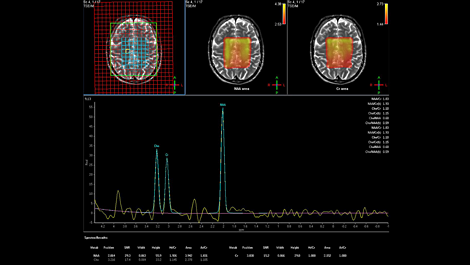 Spectroscopy - Brain MR Clinical application