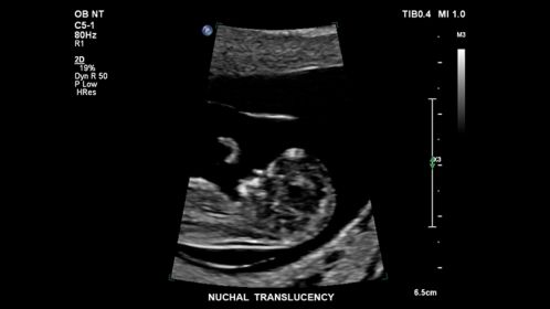 Nuchal Translucency