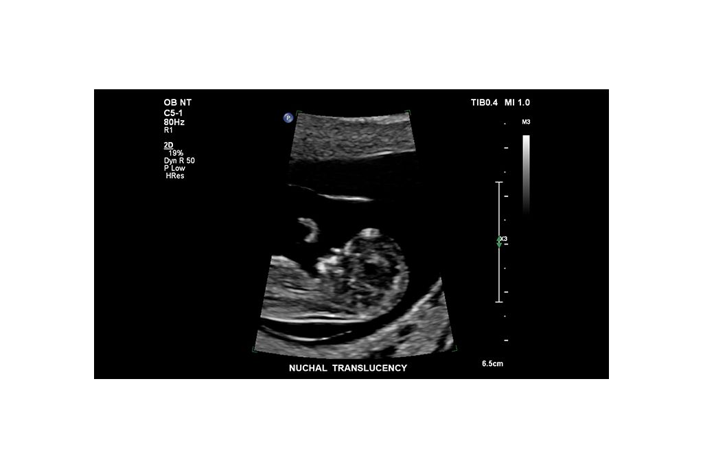 Nuchal Translucency