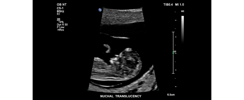 Nuchal Translucency