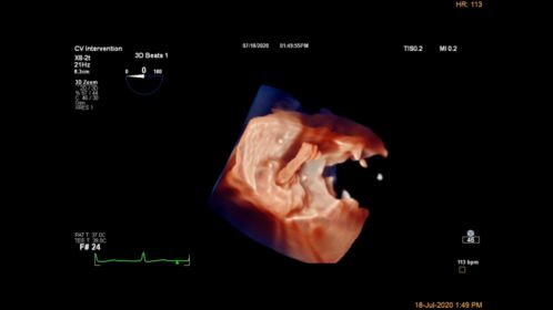Live 3D TEE - Occluder device