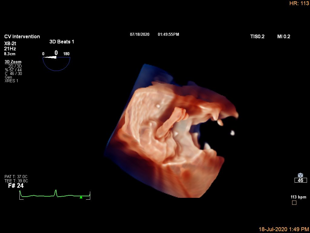 Live 3D TEE - Occluder device