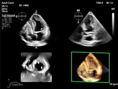 Multiple echocardiography views displaying 2D and 3D cardiac imaging of the heart