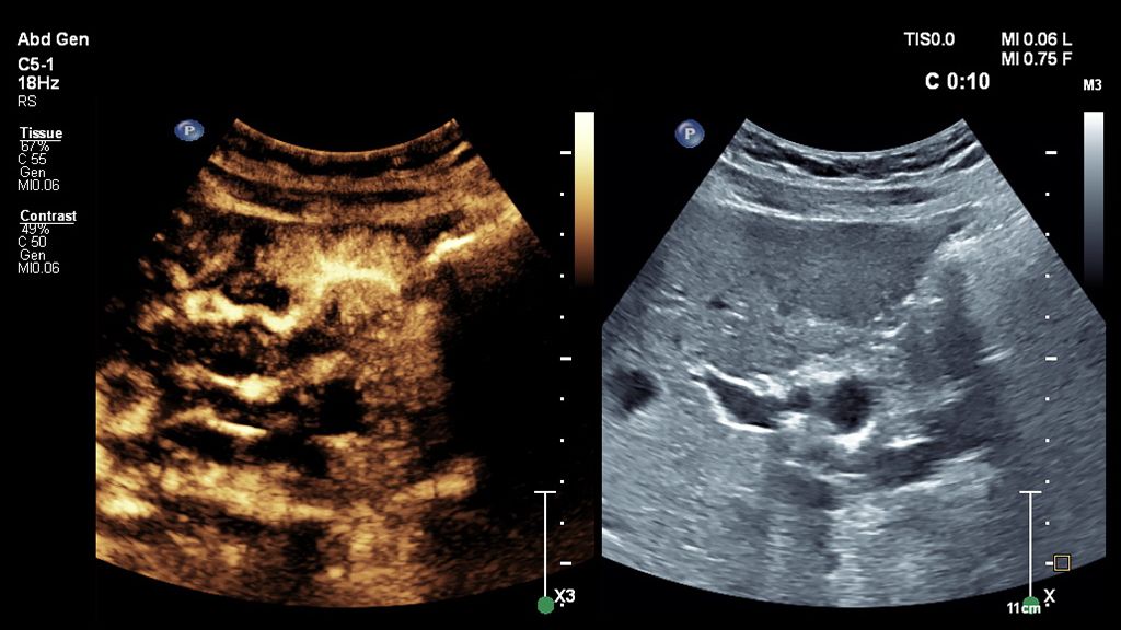 Clinical image showing CEUS FNH TTP with reference