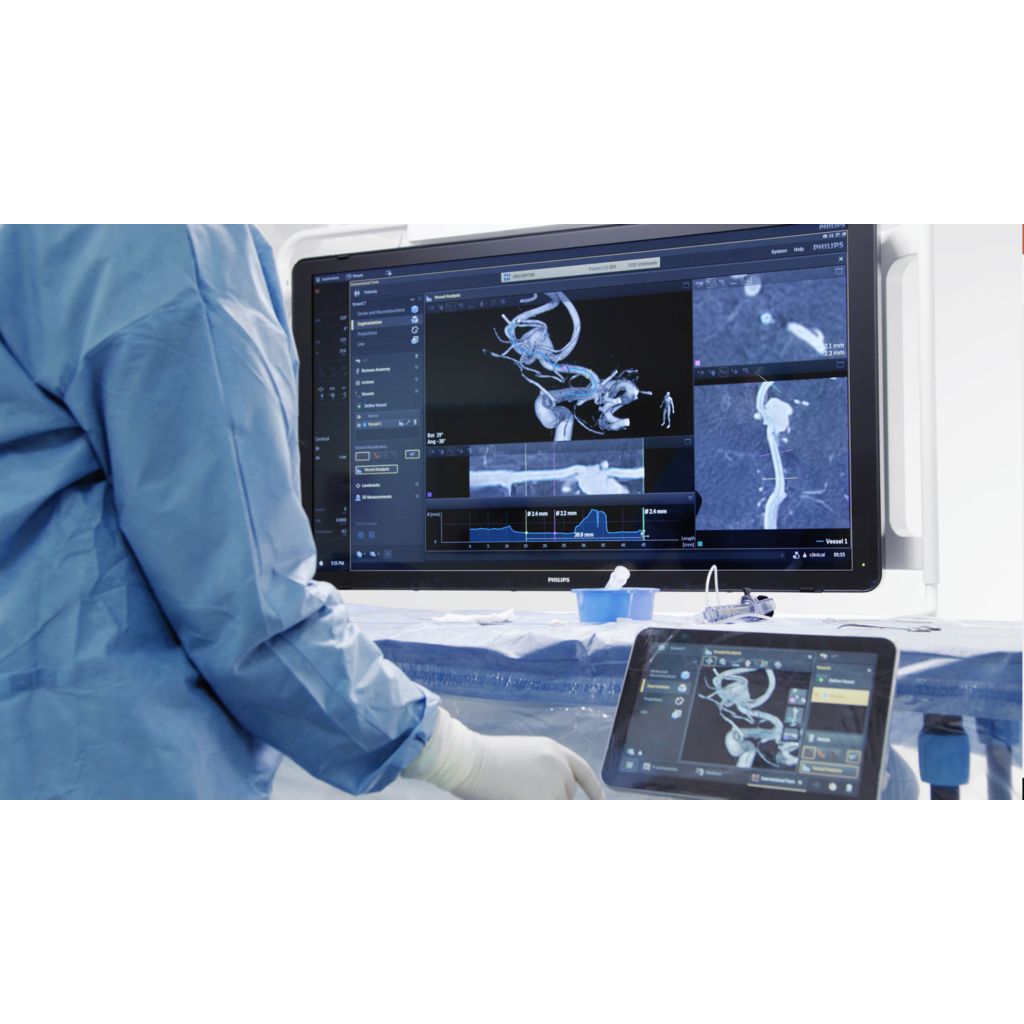 SmartCT Vessel Analysis with next generation vessel tracking supports treatment planning