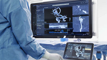 El análisis vascular de SmartCT con el seguimiento de vasos de próxima generación apoya la planificación del tratamiento