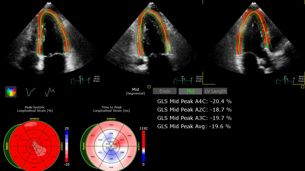 VM 11.0 Transcend Affiniti CVx Autostrain Midlayer app clinical image ultrasound