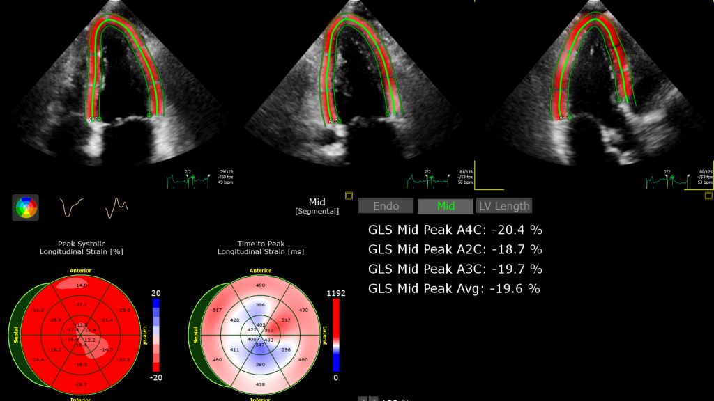 Global, regional and mid-layer strain of LV shown utilizing AutoStrain LV feature.​ 