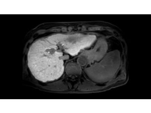 SmartSpeed 3D FreeBreathing - Abdomen MR Clinical Applications