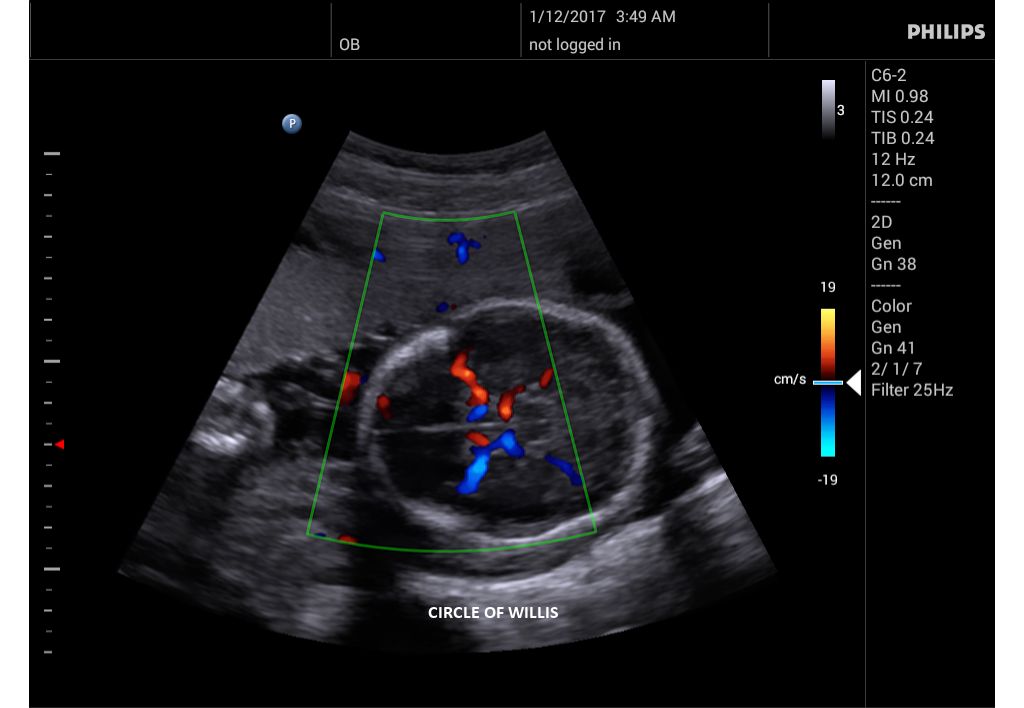 Innosight clinical image Cirlce of Willis