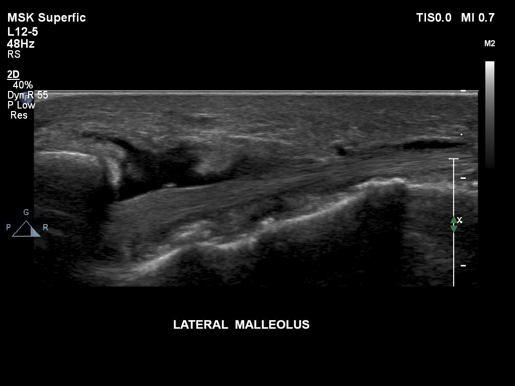 Lateral malleolus