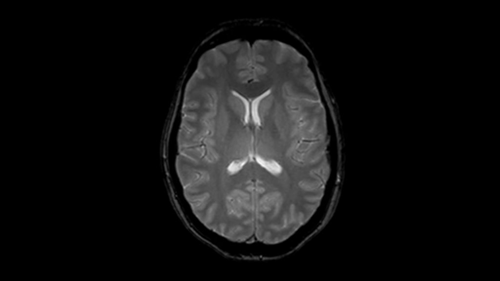 T2* FFE clinical image of the brain