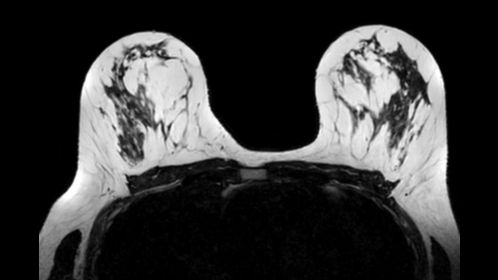 3D T2w BreastView