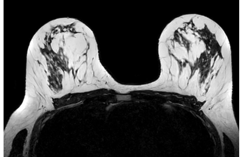 3D T2w BreastView