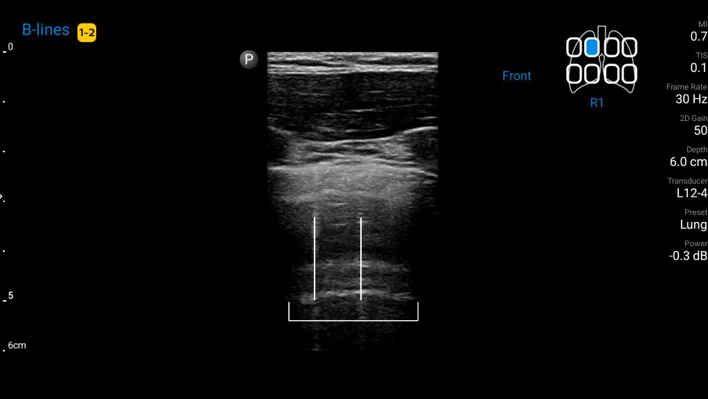 Lung ultrasound demonstrating auto B-Lines feature using L12-4 transducer.