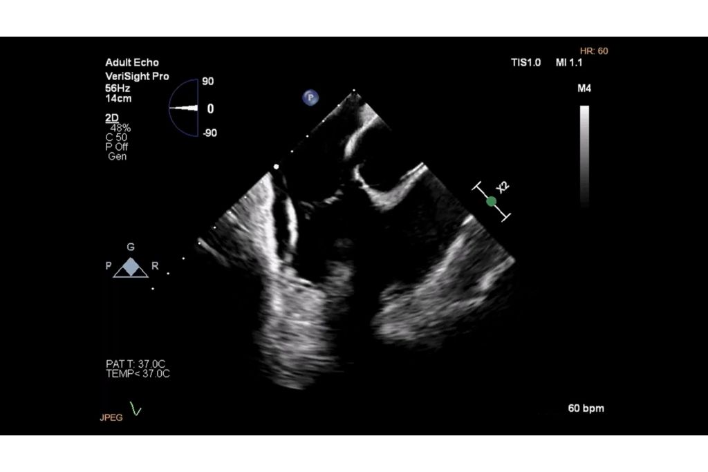 Home view of tricuspid valve and right ventricular outflow track
