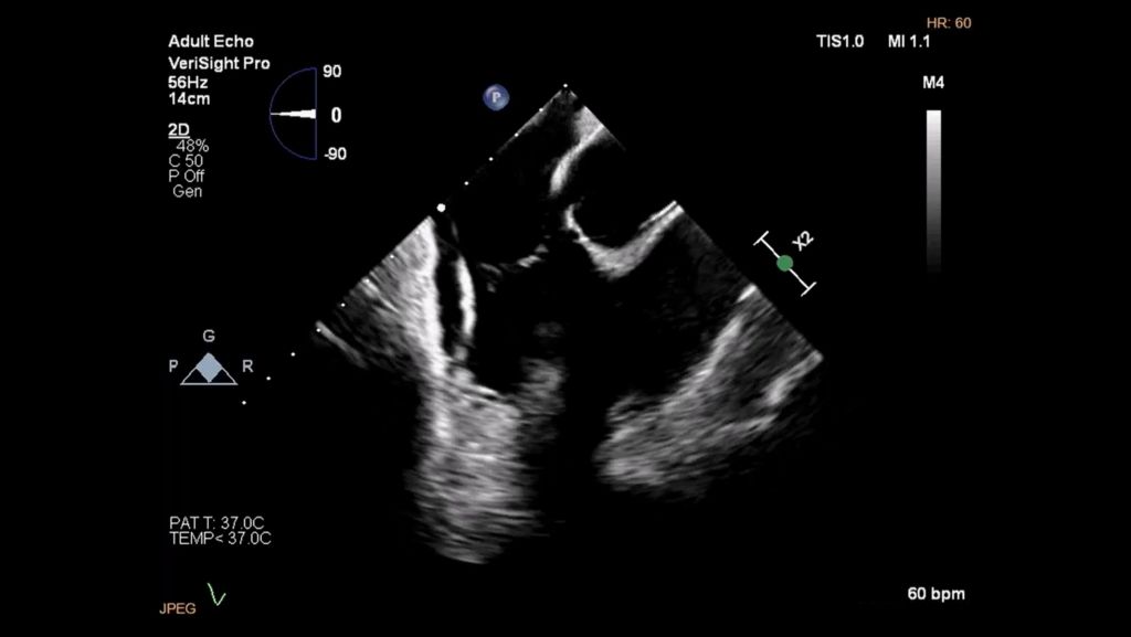 Home view of tricuspid valve and right ventricular outflow track