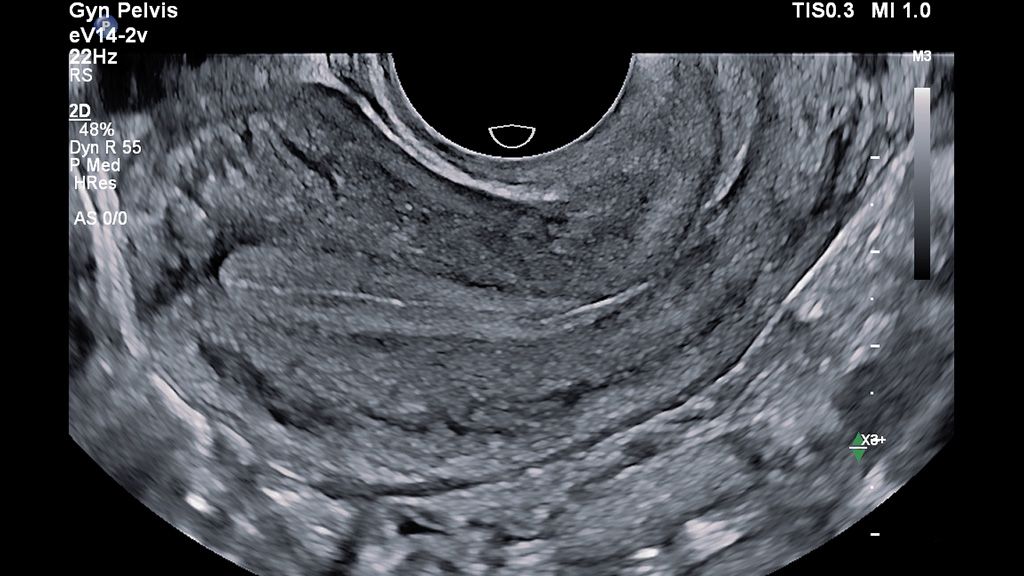 eV14-2v clinical image on EPIQ showing widescreen 2D of pelvis