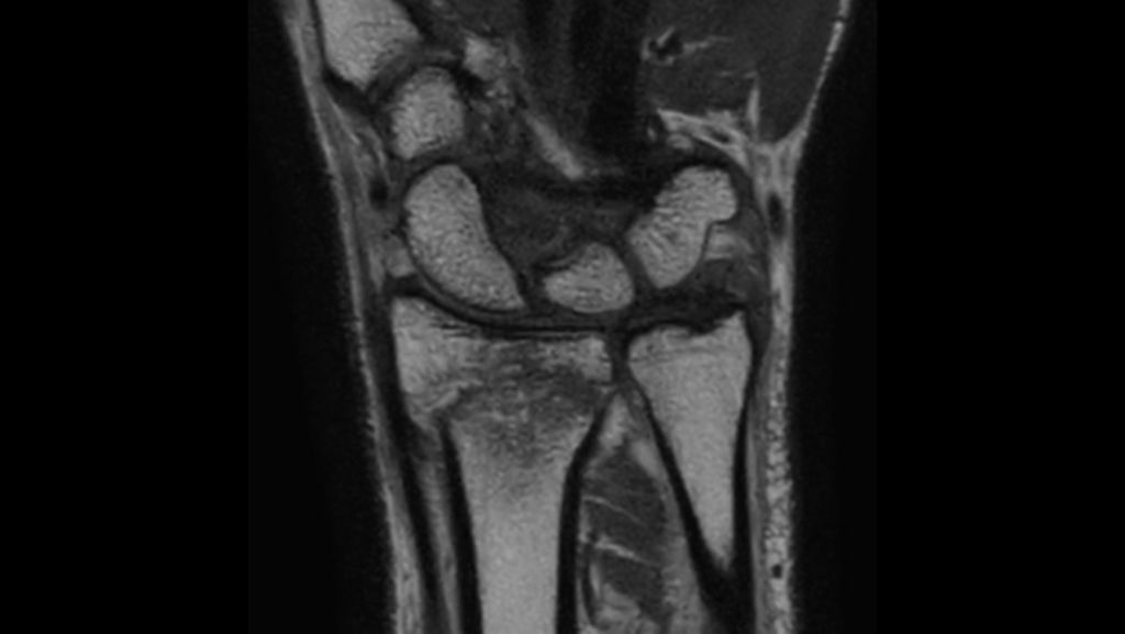 

Wrist 3D VIEW PDw TSE

