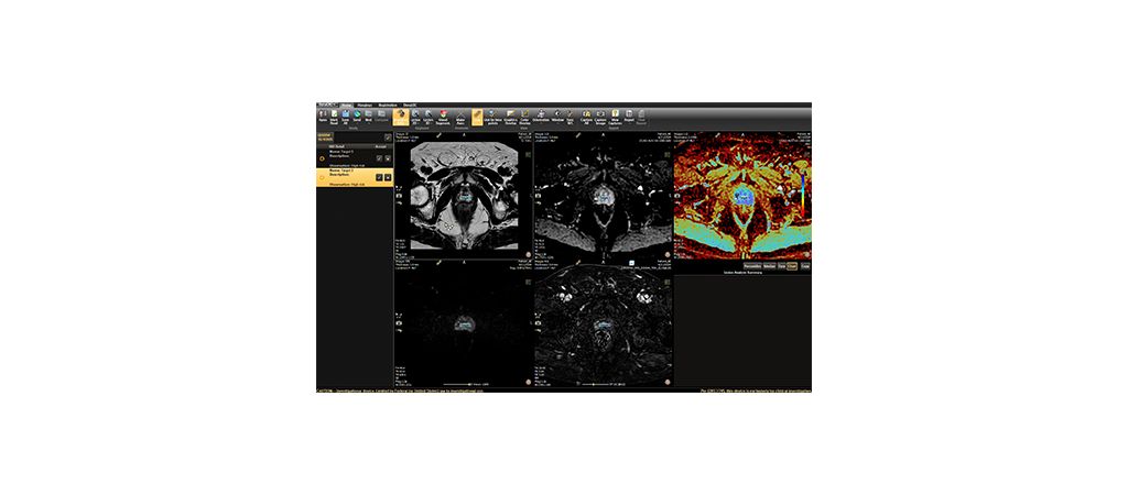 AI-Assisted lesion detection