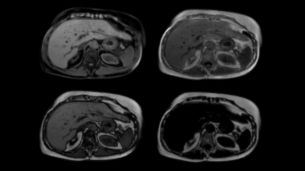 Compressed SENSE - Abdomen 