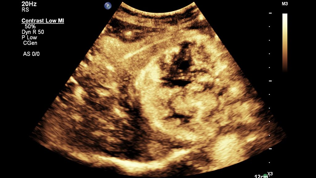 Abdominal clinical image showing CEUS using C5-1 transducer