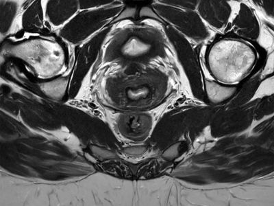 MRI-dwarsdoorsnede van de bekkenanatomie voor diagnostische beeldvorming
