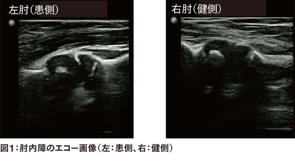 図1：肘内障のエコー画像（左：患側、右：健側）