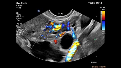Ovary ultrasound image shown with Flow Viewer using C9-4v transducer