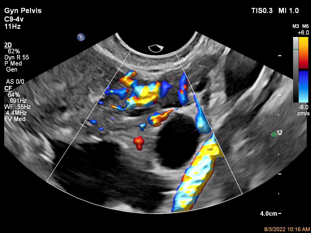 Ovary ultrasound image shown with Flow Viewer using C9-4v transducer