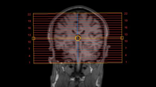 SmartExam Brain - Auto alignment of the imaging slices