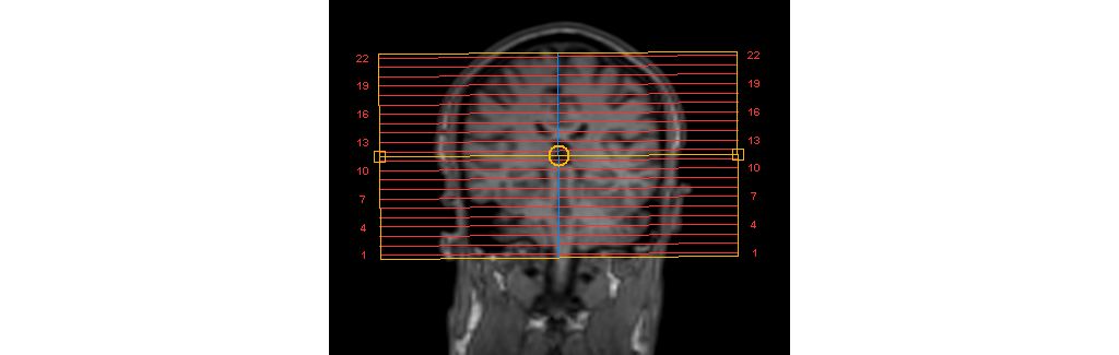 SmartExam Brain - Auto alignment of the imaging slices