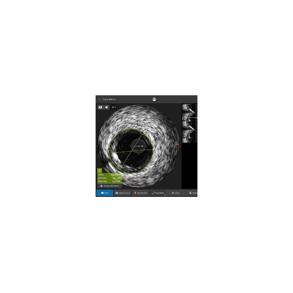 IVUS