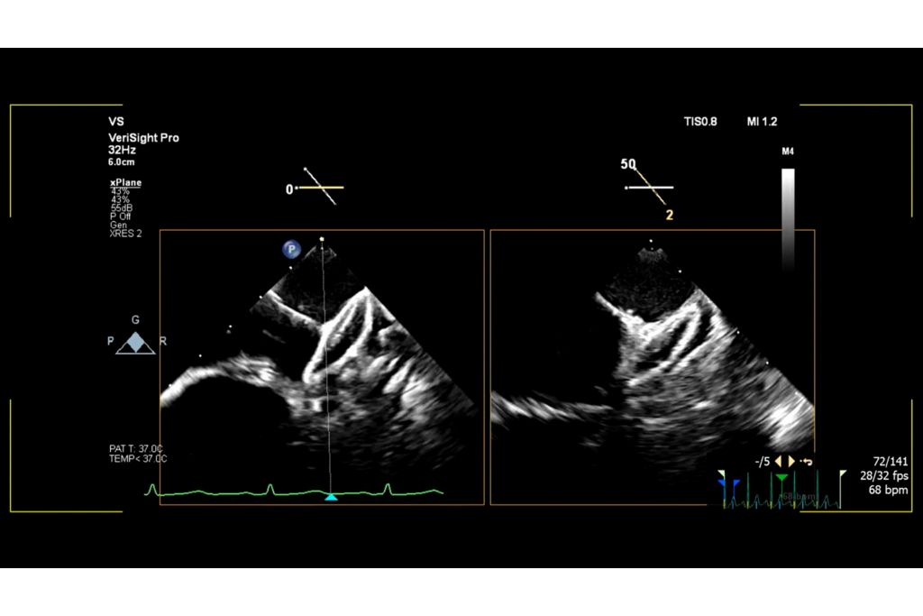 Left atrial appendage (LAA) AMPLATZER AMULET deployment in xPlane