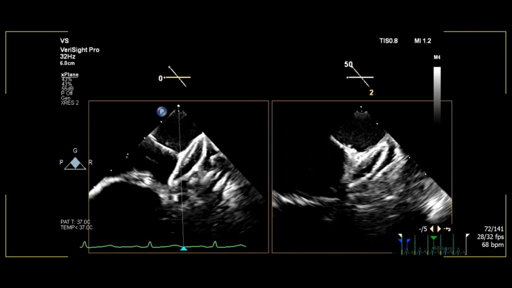 Left atrial appendage (LAA) AMPLATZER AMULET deployment in xPlane