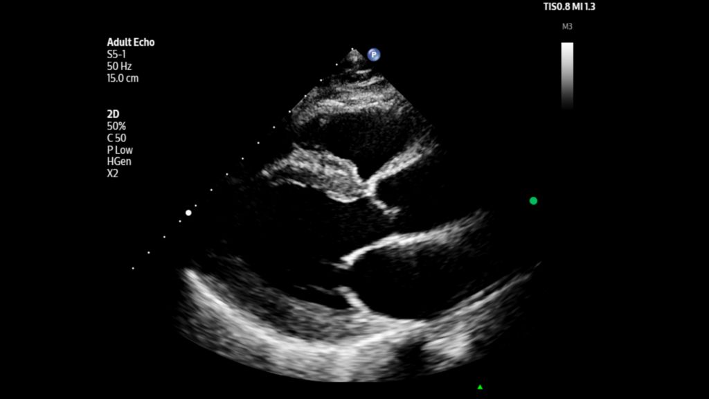 Adult echo PLAX shown using S5-1 transducer on Flash 5100 POC.