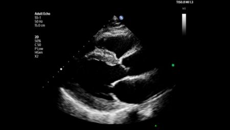 Adult echo PLAX shown using S5-1 transducer.