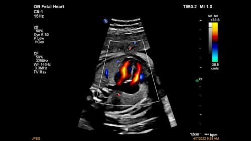 C5-1 Fetal Heart Color Flow with Flow Viewer