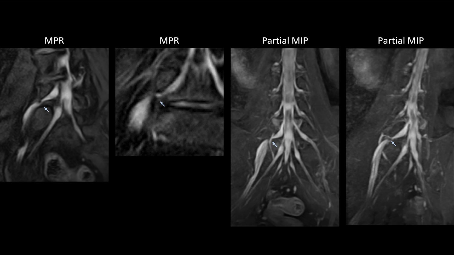 Nerve VIEW imaging of right L5 radiculopathy