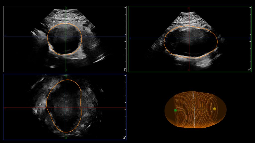 EPIQ utilizing the X6-1 transducer for the Philips AAA model