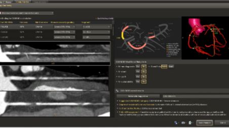 Analisi cardiaca completa con funzionalità CAD-RADS