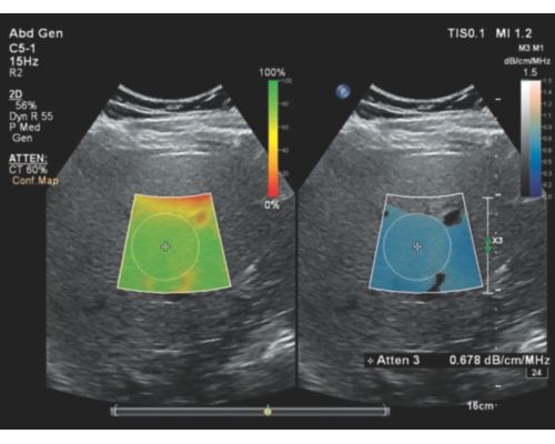 Philips liver fat quantification ultrasound clinical image