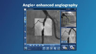 Philips CoreVision advanced imaging solution case review