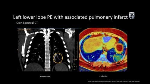 IQon Spectral left lower lobe PE associated Pulmonary Infarct