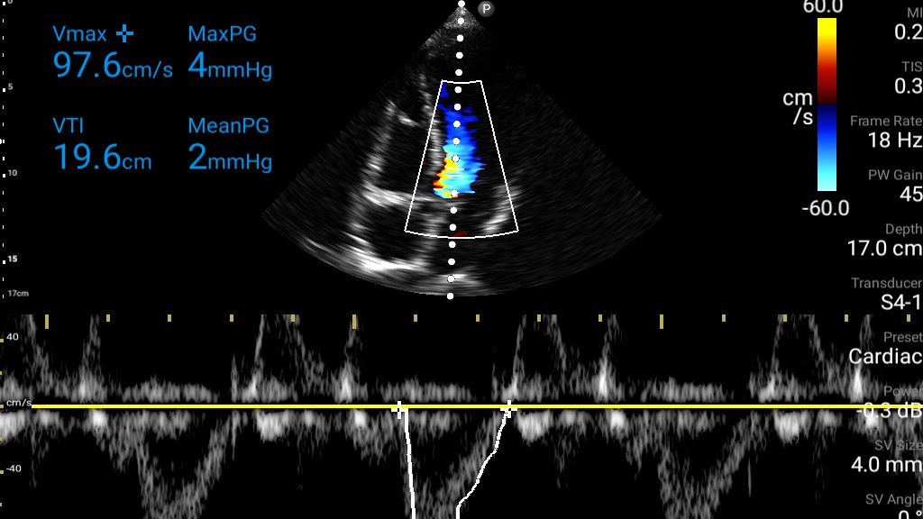 Cardiac ultrasound using color and Pulsed Wave Doppler shown using S4-1 transducer on Lumify.