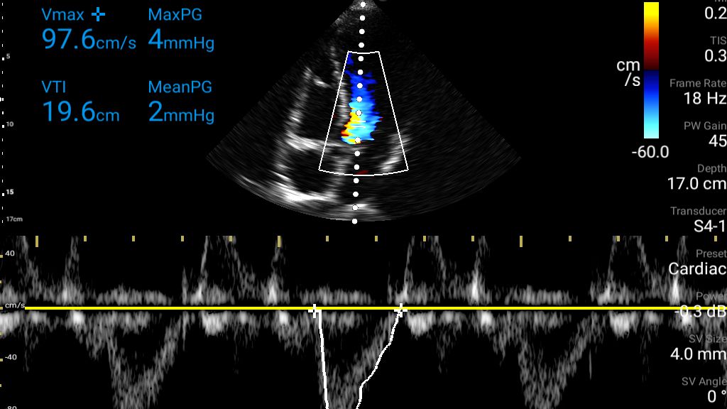 Cardiac ultrasound using color and Pulsed Wave Doppler shown using S4-1 transducer on Lumify.